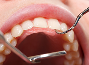 Oral Cancer Detection